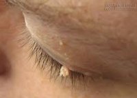 Bé trai 6 tuổi dính sùi mào gà chỉ vì một lần vui vẻ của bố