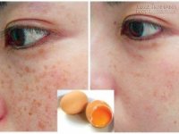 Muốn trị nám da siêu tốc, hãy ghi sổ công thức đơn giản dưới đây