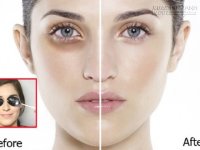 Giảm quầng thâm và bọng mắt bằng những cách không thể tin được