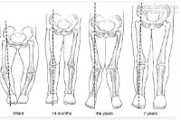 Nguyên nhân và cách chữa chân vòng kiềng ở trẻ nhỏ