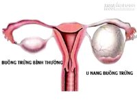 Phương thuốc dân gian chữa dứt điểm u nang buồng trứng giai đoạn đầu