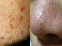 Loại bỏ mụn đầu đen nhờ 4 nguyên liệu ngày nào cũng ăn