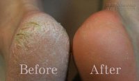 Bất ngờ với công thức siêu dễ đánh bay gót chân nứt nẻ mùa hanh khô