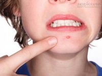 Bí kíp hô biến đốm mụn xấu xí chỉ sau 1 đêm