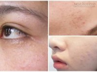 Đi tìm nguyên nhân và cách trị hoàn toàn mụn ẩn, mụn chìm li ti