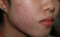 Kinh nghiệm trị mụn dứt điểm chỉ trong 2 tuần