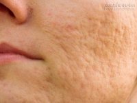Trị sẹo rỗ lồi lõm nhờ 4 nguyên liệu rẻ tiền, dễ kiếm