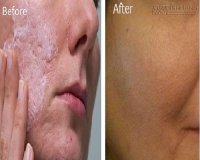 Hết sẹo rỗ, se khít lỗ chân lông hiệu quả chỉ với 1 nguyên liệu này