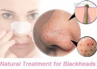 Dọn sạch mụn đầu đen ngay tức thì với hỗn hợp đơn giản này
