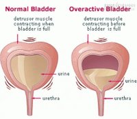 Dứt viêm bàng quang ngay tức khắc nhờ hỗn hợp 2 thành phần