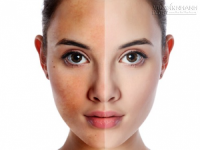 Xử lý nám da dễ chưa từng thấy bằng những nguyên liệu sẵn có