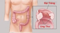 Ung thư đại trực tràng: Triệu chứng, nguyên nhân và cách phòng tránh