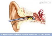 7 bí quyết loại bỏ ráy tai an toàn, không hề đau