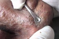 Trộn 3 thứ này và chà mặt, giúp tống cổ mụn đầu đen mãi mãi