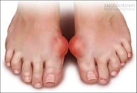 Trị dứt bệnh gút bằng các nguyên liệu đơn giản trong nhà bếp