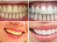 Không cần đến nha sĩ, hàm răng vẫn trắng sáng, đều tăm tắp với những mẹo sau