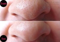 Tạm biệt mụn đầu đen với hỗn hợp chanh muối cực đơn giản