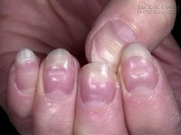 Nhìn móng tay đoán bệnh