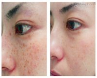 Hết nám và tàng nhang chỉ với 2 thành phần đơn giản