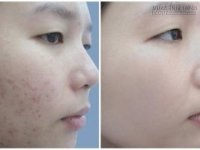 Tạm biệt vết thâm mụn trong 7 ngày với những phương pháp rẻ bèo