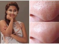 Bí quyết lột sạch mụn đầu đen ở mũi chỉ trong 5 phút