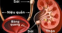Bài thuốc quý đánh bật sỏi thận chỉ trong vài ngày không cần mổ
