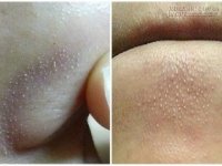 Tự làm keo lột mụn cám ở cằm và cánh mũi hiệu quả hơn đi mua