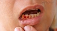 Chảy máu chân răng: Dấu hiệu bệnh ung thư nguy hiểm bạn phải biết
