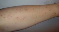 Số lượng nốt ruồi trên cánh tay dự báo nguy cơ ung thư da