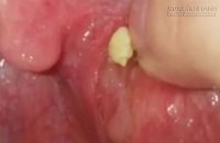 Sỏi amidan, một căn nguyên chính làm cho miệng bạn hôi thối