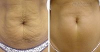 Kéo căng vùng da bị chảy xệ một cách tự nhiên