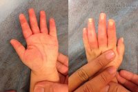 Cách sơ cứu khi con bị bỏng canh