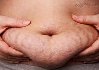 Tâm sự của bà mẹ bỉm sữa và bức ảnh rạn bụng sau sinh khiến hàng triệu phụ nữ đồng cảm