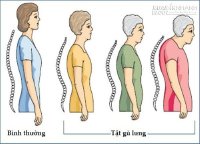 Có bí kíp giữ dáng chuẩn này, chẳng bao giờ bị gù lưng