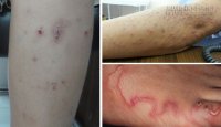 Triệu chứng nhiễm giun sán ít ngờ nhất