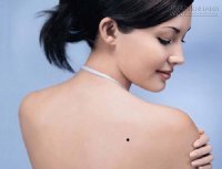 Nốt ruồi sau lưng: May hay xui?