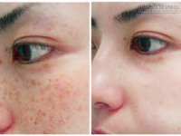 Hô biến làn da nám, tàn nhang trở nên trắng mịn với công thức 15 phút rẻ bèo