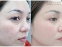 Không ngờ 2 thực phẩm này lại có thể trị vĩnh viễn nám và tàn nhang