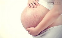 3 giải pháp phối hợp đánh tan vết rạn sau sinh