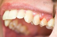 Nha chu: Căn bệnh răng miệng nguy hiểm nhất bạn phải biết