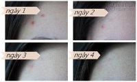 Nguyên liệu thần thánh giúp đánh bay mụn chỉ trong 4 ngày