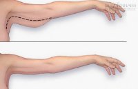 Học cách đốt mỡ thừa dưới cánh tay trong 30 giây