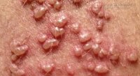 Bệnh nguy hiểm dễ lây khi quan hệ cần phòng trước khi quá muộn