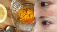 Hô biến vết sạm, nám, tàn nhang chỉ mất 15 phút để thực hiện