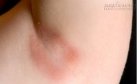 Trị nấm ngứa da, hãy sử dụng 2 nguyên liệu trong nhà bếp này