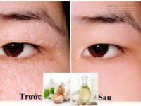 Không ai ngờ 3 loại thực phẩm này lại có thể đánh bay mụn thịt lì lợm