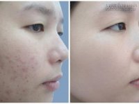 Cách làm mụn tự chui ra mà không cần nặn