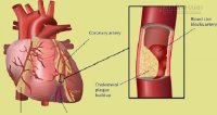 Công thức điều trị tắc động mạch và mỡ máu nhanh nhất tại nhà