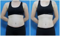 Uống 2 loại nước này trước khi ngủ để đánh tan mỡ bụng trong 15 ngày