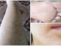 2 cách cực đơn giản để tạm biệt tình trạng da rắn xấu xí mùa hanh khô